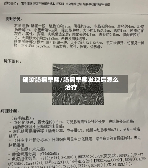 确诊肠癌早期/肠癌早期发现后怎么治疗