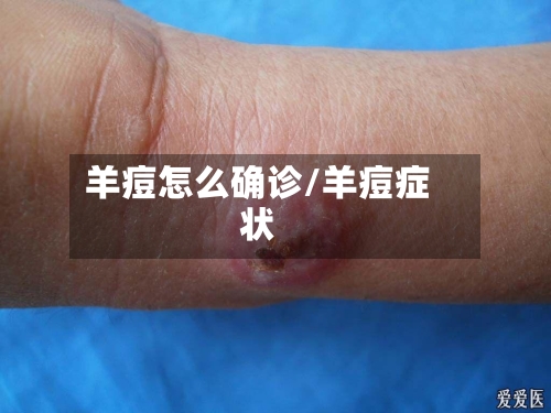 羊痘怎么确诊/羊痘症状