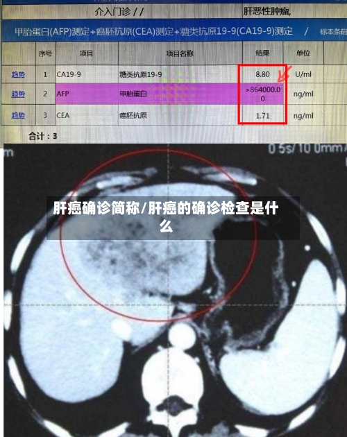 肝癌确诊简称/肝癌的确诊检查是什么-第2张图片