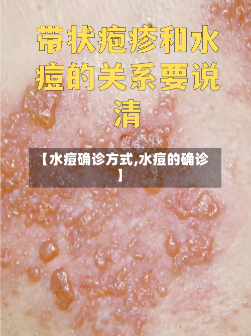 【水痘确诊方式,水痘的确诊】