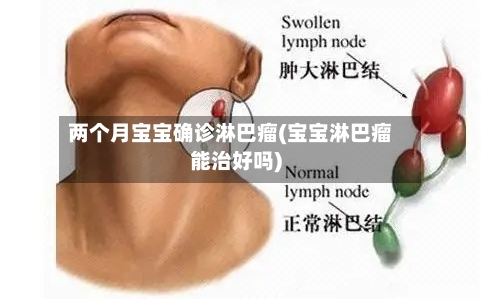 两个月宝宝确诊淋巴瘤(宝宝淋巴瘤能治好吗)-第3张图片