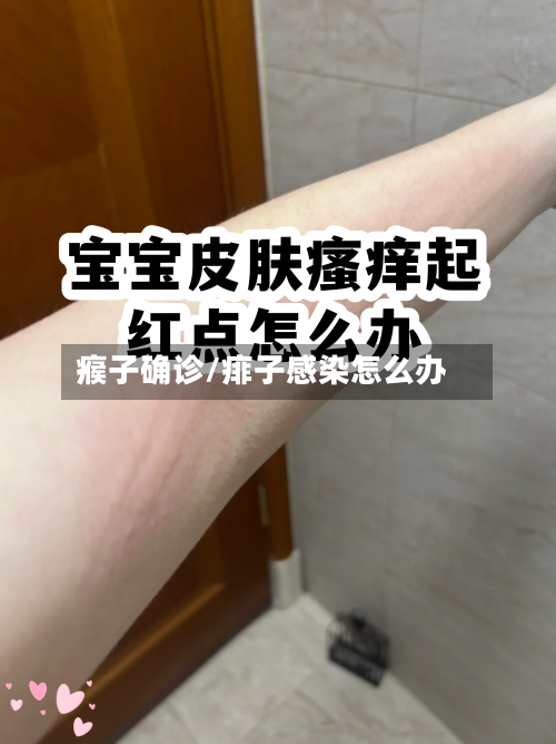 瘊子确诊/痱子感染怎么办-第2张图片